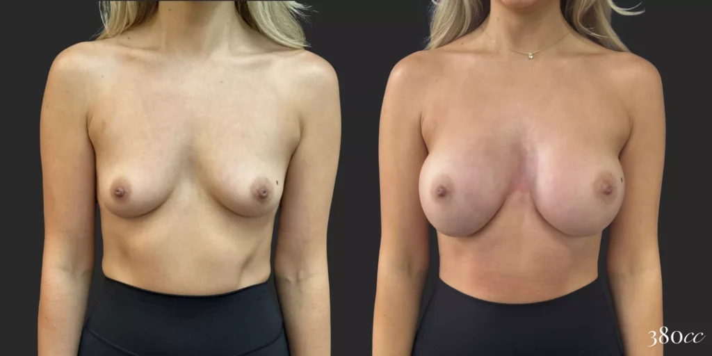 Breast Augmentation #053, before and after photo