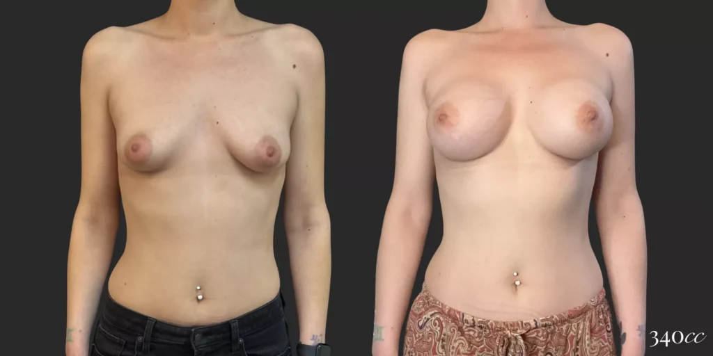 Breast Augmentation #056, before and after photo