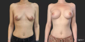 Breast Augmentation #056, before and after photo