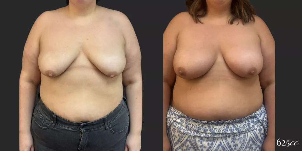 Breast Augmentation #057, before and after photo
