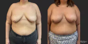 Breast Augmentation #057, before and after photo