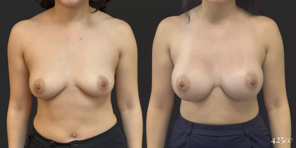 Breast Augmentation #058, before and after photo