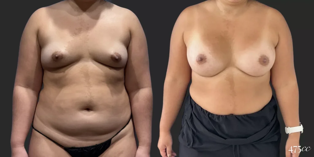 Breast Augmentation #062, before and after photo