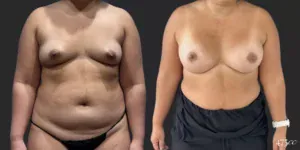 Breast Augmentation #062, before and after photo