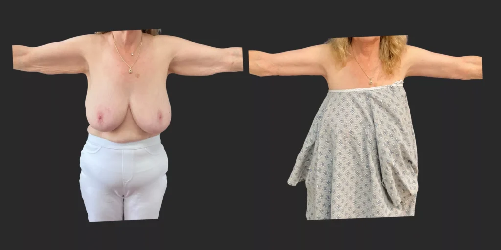 Arm Lift #003, before and after photo