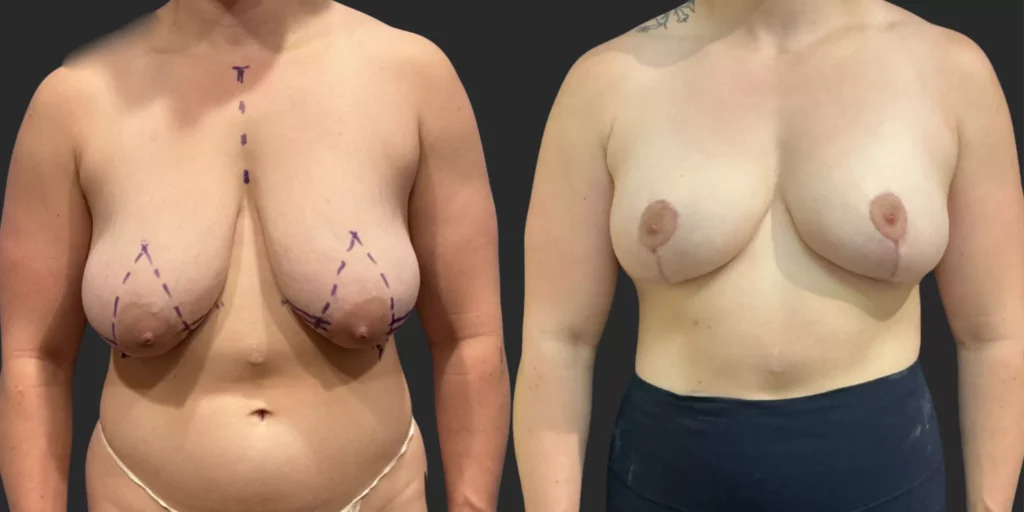 Breast Reduction #001, before and after photo