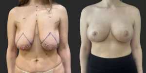 Breast Reduction  #002, before and after photo