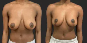 Breast Reduction #003, before and after photo