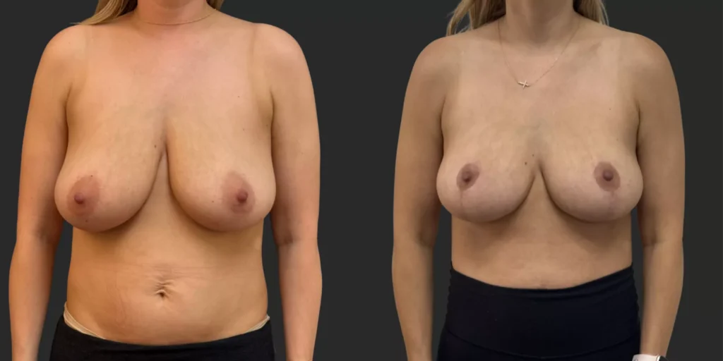 Breast Reduction #004, before and after photo