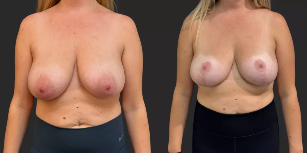 Breast Reduction #005, before and after photo