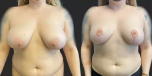 Breast Reduction #006, before and after photo