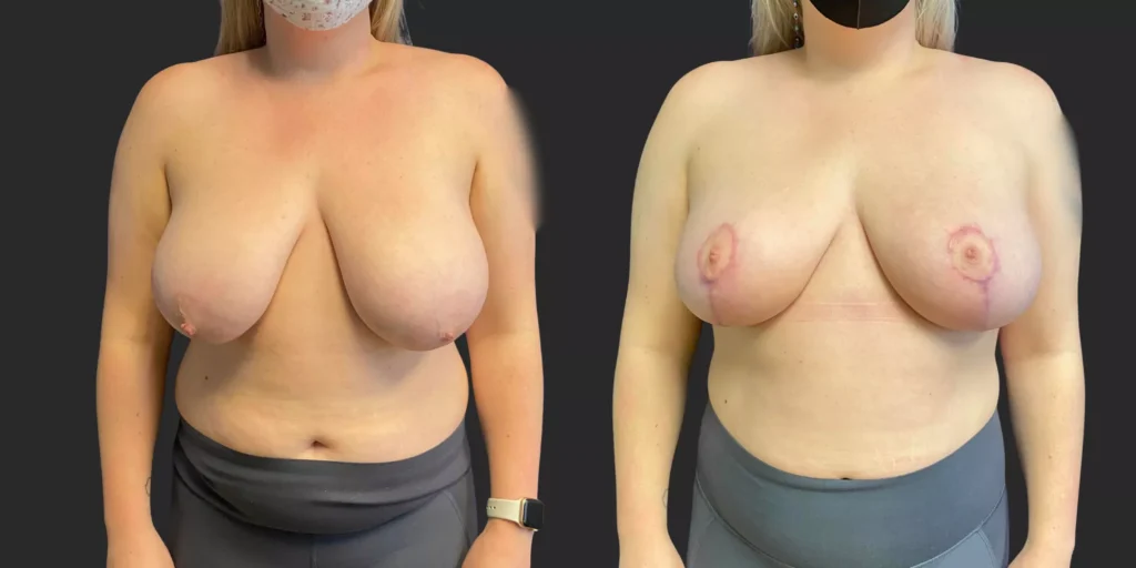 Breast Reduction #007, before and after photo