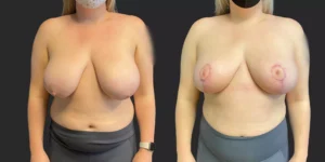 Breast Reduction #007, before and after photo