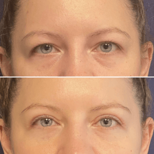 Eyelid Lift #010, before and after photo
