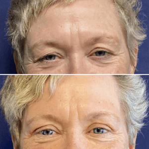 Eyelid Lift #011, before and after photo