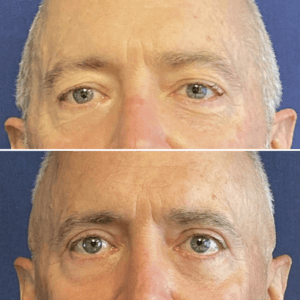 Eyelid Lift #012, before and after photo