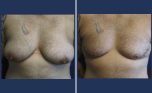 FTM Chest Masculinization Surgery #002, before and after photo