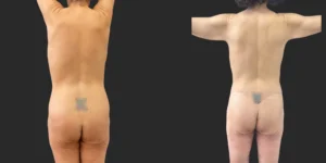 Fleur de lis Belt Lipectomy Abdominoplasty with Bilateral Medial Thigh Lift #001, before and after photo, view 2