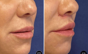 Lip Lift #002, before and after photo