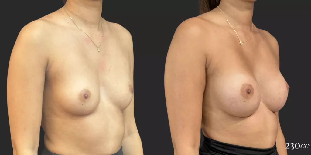 Breast Augmentation #001, before and after photo, view 2