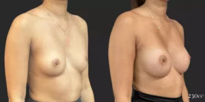 Breast Augmentation #001, before and after photo, view 2