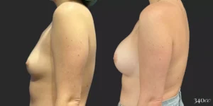 Breast Augmentation #003, before and after photo, view 2