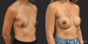 Breast Augmentation #005, before and after photo, view 2