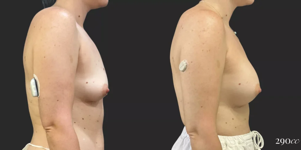 Breast Augmentation #006, before and after photo, view 2
