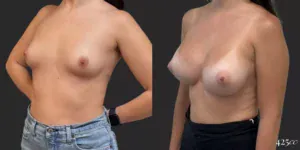 Breast Augmentation #008, before and after photo, view 2