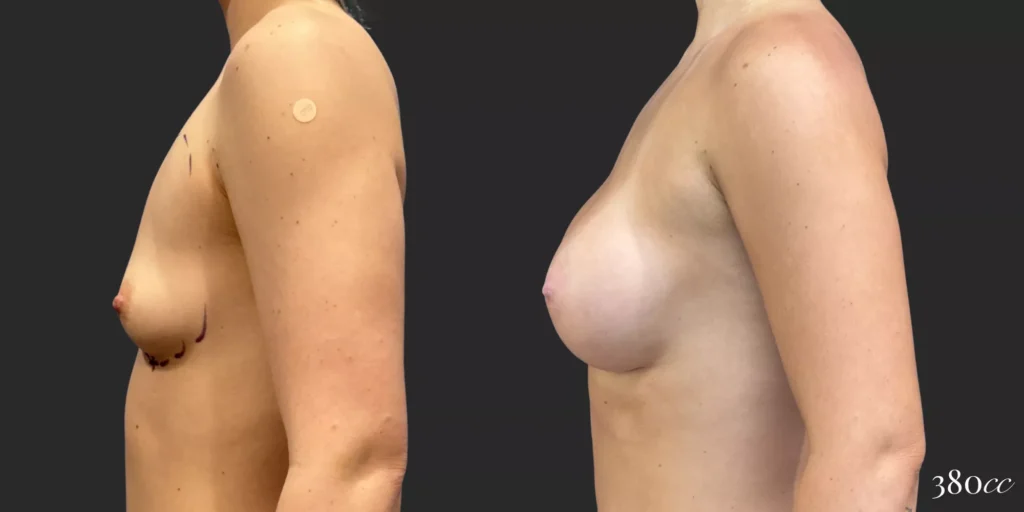 Breast Augmentation #009, before and after photo, view 2