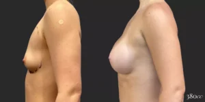 Breast Augmentation #009, before and after photo, view 2