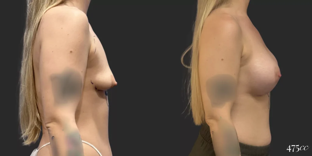 Breast Augmentation #011, before and after photo, view 2