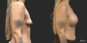 Breast Augmentation #011, before and after photo, view 2