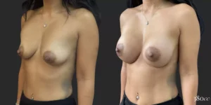Breast Augmentation #014, before and after photo, view 2