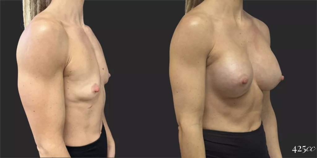 Breast Augmentation #015, before and after photo, view 2