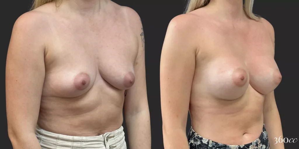 Breast Augmentation #017, before and after photo, view 2