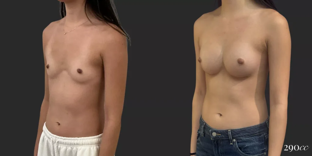 Breast Augmentation #019, before and after photo, view 2