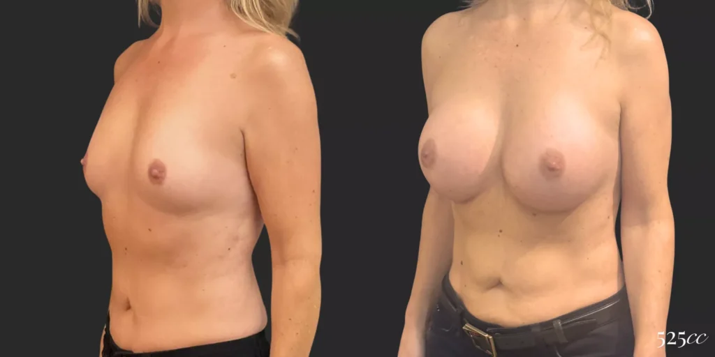 Breast Augmentation #020, before and after photo, view 2