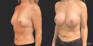 Breast Augmentation #020, before and after photo, view 2
