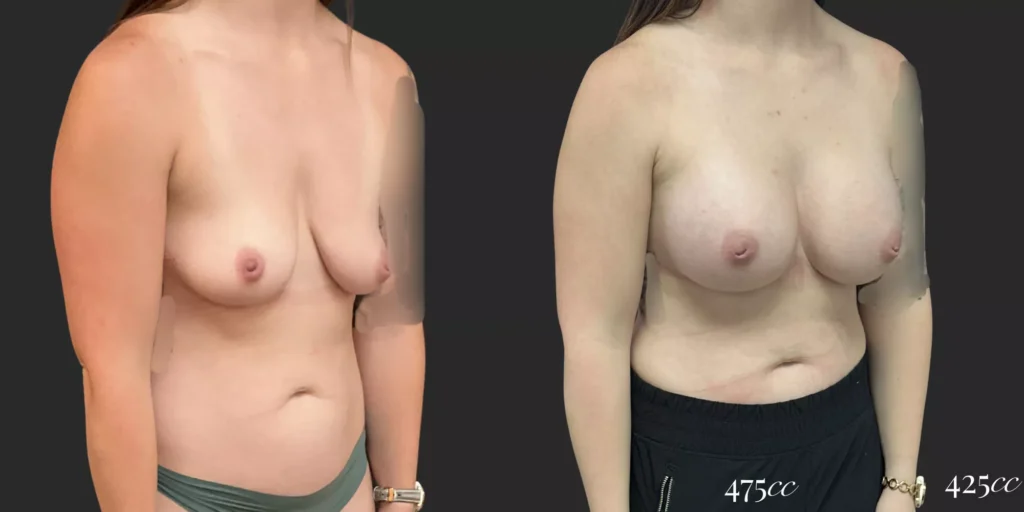 Breast Augmentation  #021, before and after photo, view 2
