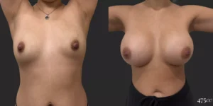 Breast Augmentation  #022, before and after photo, view 2