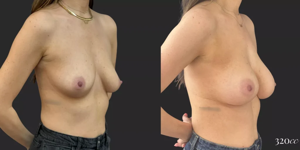 Breast Augmentation  #023, before and after photo, view 2