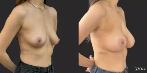 Breast Augmentation  #023, before and after photo, view 2