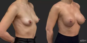 Breast Augmentation  #024, before and after photo, view 2