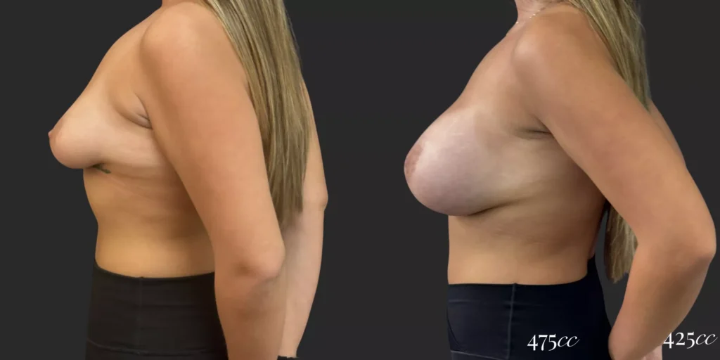 Breast Augmentation  #025, before and after photo, view 2