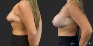Breast Augmentation  #025, before and after photo, view 2