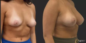 Breast Augmentation  #028, before and after photo, view 2