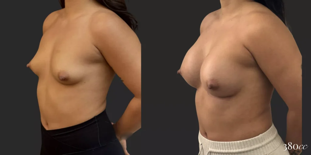 Breast Augmentation #029, before and after photo, view 2