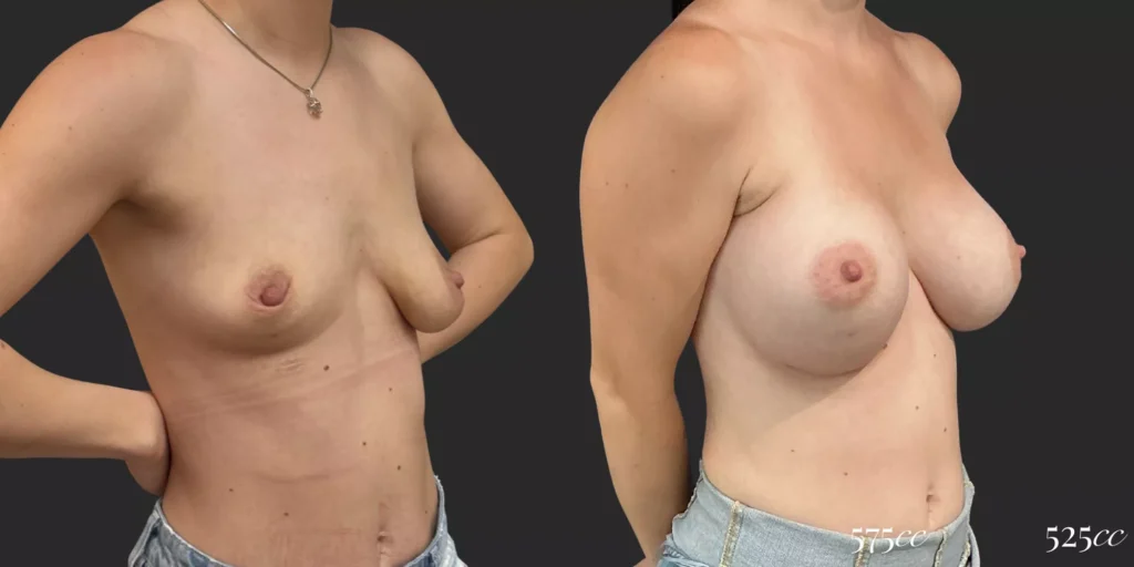 Breast Augmentation #030, before and after photo, view 2