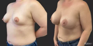 Breast Augmentation #031, before and after photo, view 2